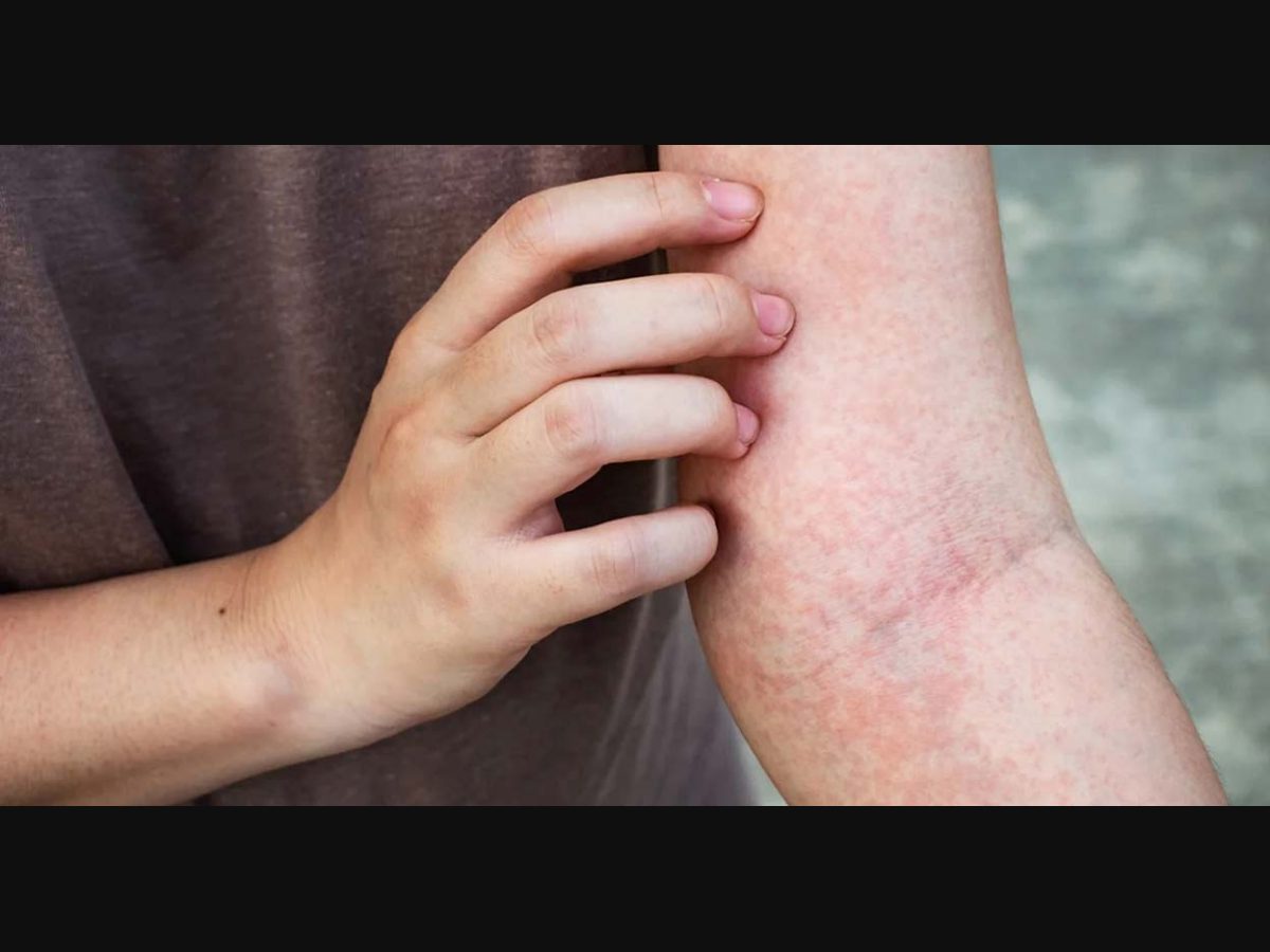 Common microbe that causes persistent itching in conditions like