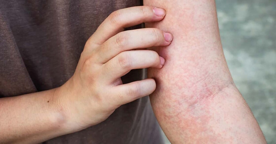 Until now, the itch that occurs with eczema and atopic dermatitis was believed to arise from the accompanying inflammation of the skin. Photo: IANS
