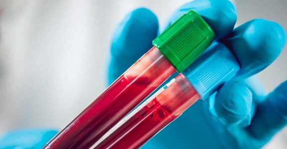 Tzar Labs announces breakthrough in early stage cancer with a simple blood test.