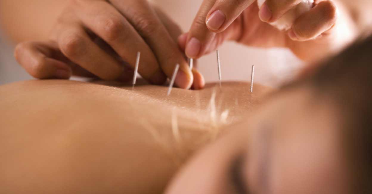 772072012 Acupuncture could potentially act on the limbic system, leading to increased levels of dopamine. Representational image: KONSTANTIN_SHISHKIN / Shutterstock