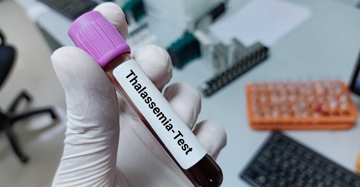 2116991090 One of the main factors that determine the success of BMT in thalassemia major is the compatibility between the donor and the recipient. Representative image: Nuzhat Gallery / Shutterstock