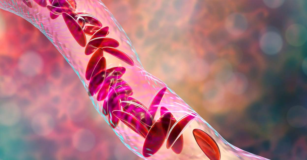 1059145434 Sickle cell disease is caused by a genetic mutation that affects the structure of hemoglobin, resulting in the deformation of red blood cells. Representative image: Dr_Microbe / iStock