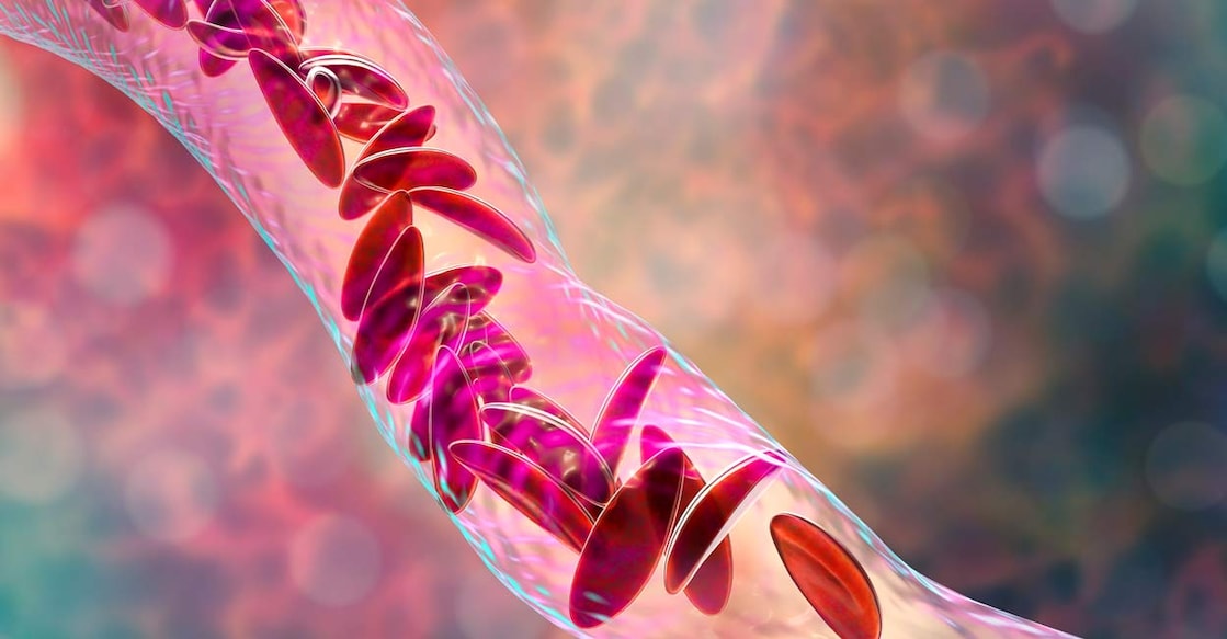 Sickle cell disease is caused by a genetic mutation that affects the structure of hemoglobin, resulting in the deformation of red blood cells. Representative image: Dr_Microbe / iStock