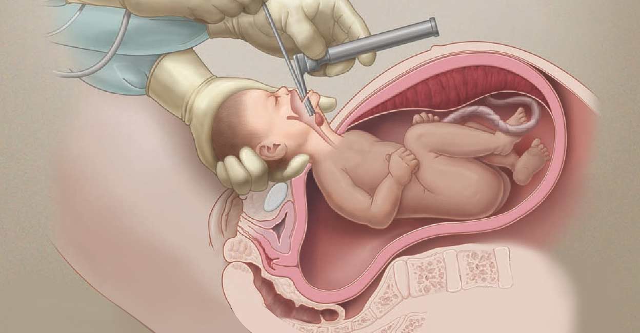 Extra Uterine Intrapartum Treatment is a procedure in which the baby is delivered partly from the uterus but leaving the placenta and umbilical cord uncut. Graphics: Special arrangement