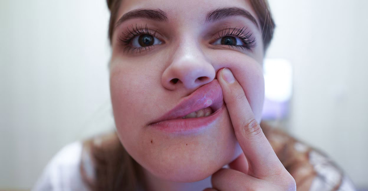 Those who consume too much packaged food, fast food, dishes that are loaded with masala and spices, acidic food items, carbonated drinks or eat piping hot food often complain of recurring mouth ulcers.  Photo: Shutterstock/Jimmy Tudeschi