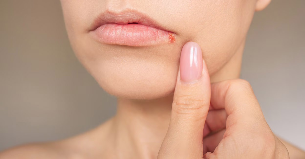 Herpes cold sores or tiny fluid-filled blisters are caused by the Herpes Simplex Virus (HSV), especially the HSV type 1 or HSV – 1 variety. Photo: iStock/ Olga Shefer