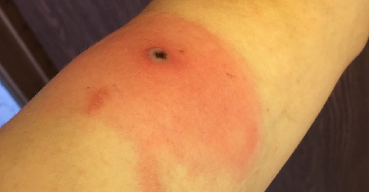 Alaskapox virus is an orthopox virus that was first identified in a patient in Fairbanks, Alaska, in 2015. Photo: State of Alaska website