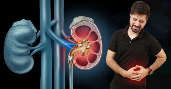 World Kidney Day: Why is kidney stone cases increasing among Gen Z ...