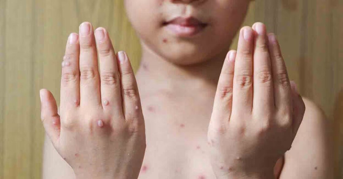 The chicken pox symptoms include fever, red marks on the body, fluid-filled blisters, headache and body pain. Photo: Shutterstock/MemoryMan