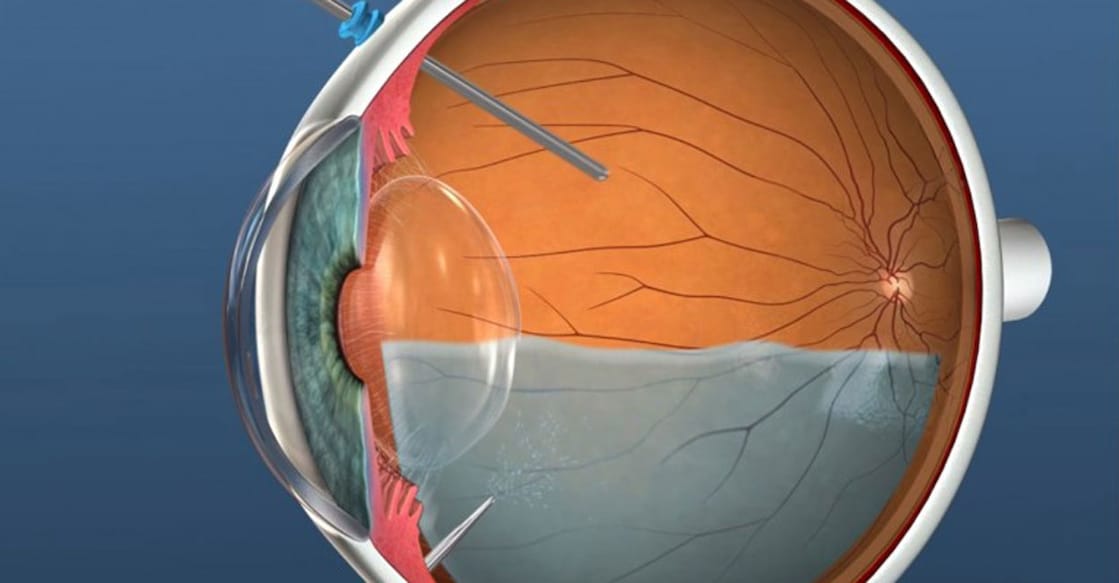 Eye strain from digital screens can exacerbate existing eye conditions, such as diabetic retinopathy or retinal detachment. Photo: IANS