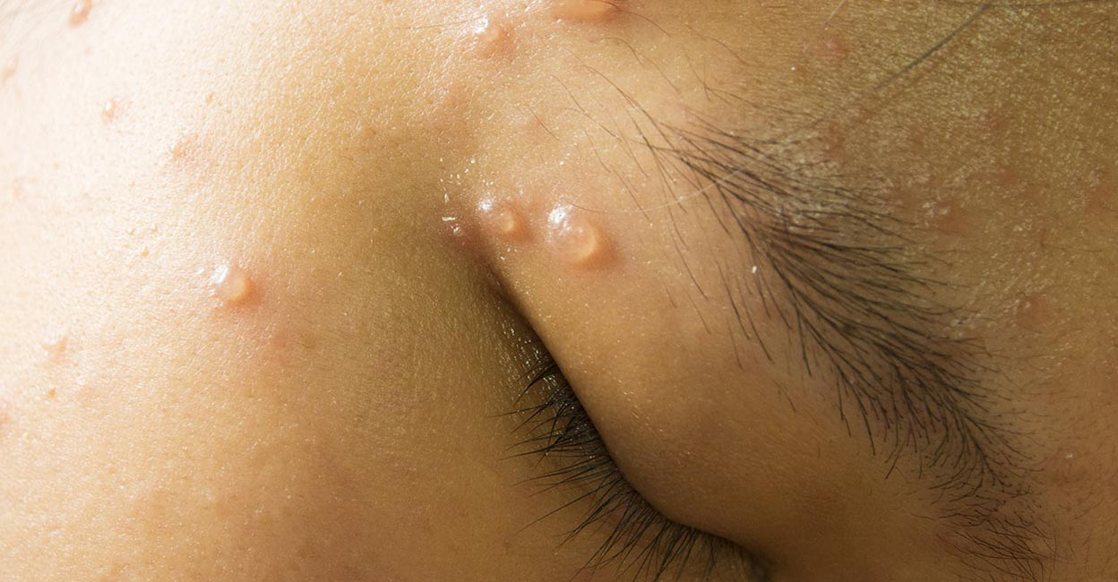 chicken-pox Chickenpox is an infectious disease caused by the virus Varicella Zoster. Photo: Shutterstock/501room
