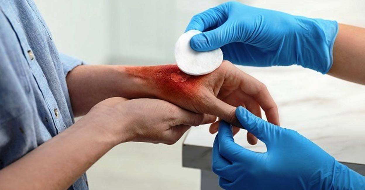 burn-injury-c Experts say that fish skin products are good at healing burn wounds. Photo: IANS