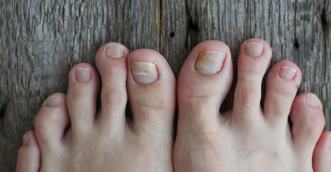 In some people, paronychia may lead to puss-filled abscesses and fungal infection too.  Photo: iStock/Irina Tiumentseva