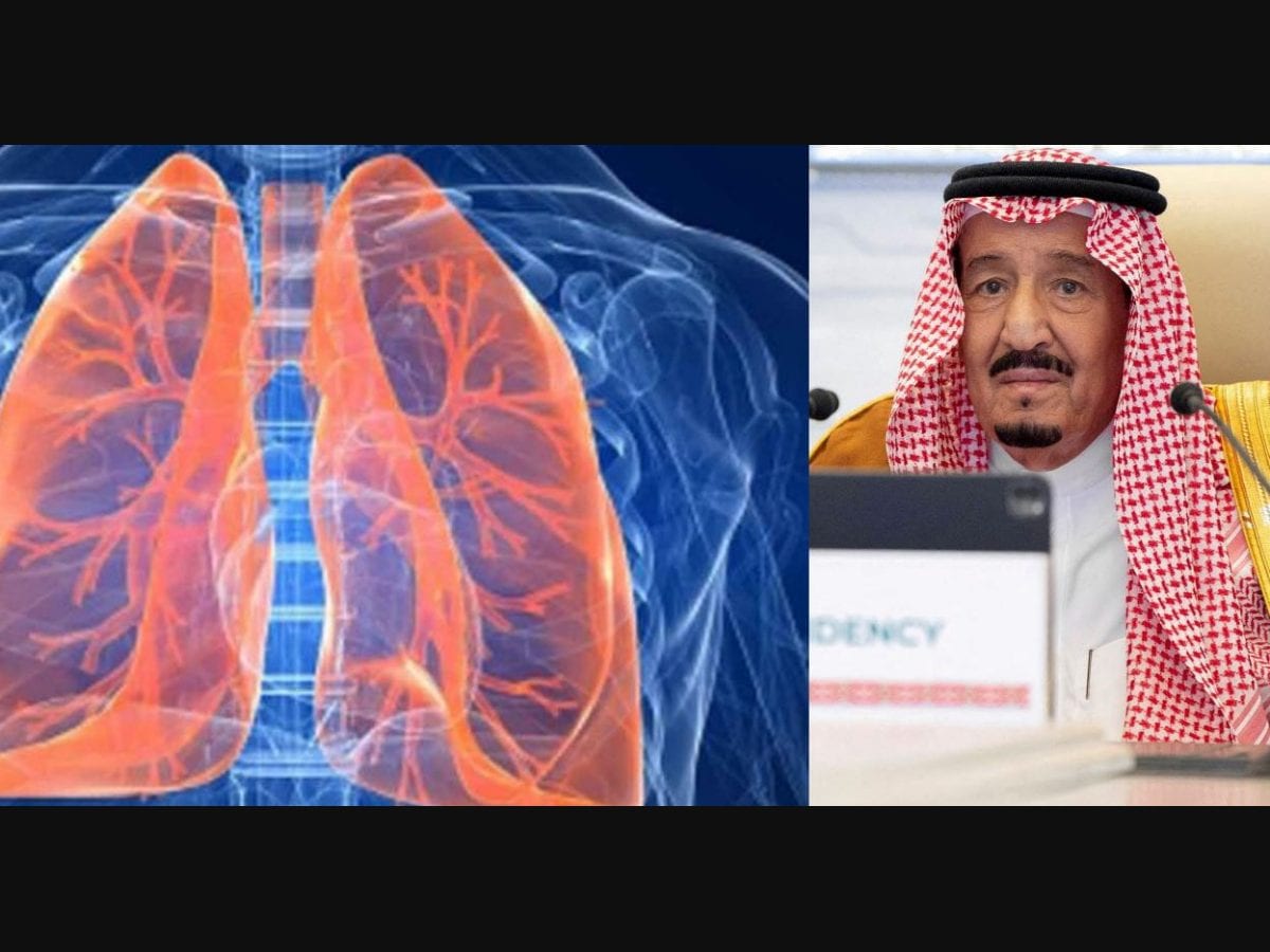 Saudi Arabia's King Salman's lung infection: What causes the condition? |  Health | Onmanorama