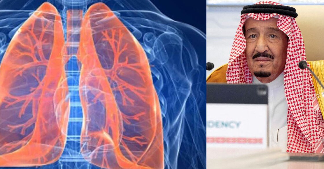King Salman's (left) medical team decided that he should undergo a treatment programme consisting of antibiotics until the lung infection went away. Photo: PTI/Shutterstock