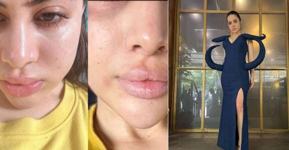 Uorfi Javed says her face is swollen most of the time due to allergies: Here's why