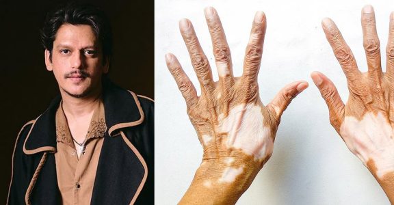 Vijay Varma reveals he has vitiligo: What is the autoimmune disease?