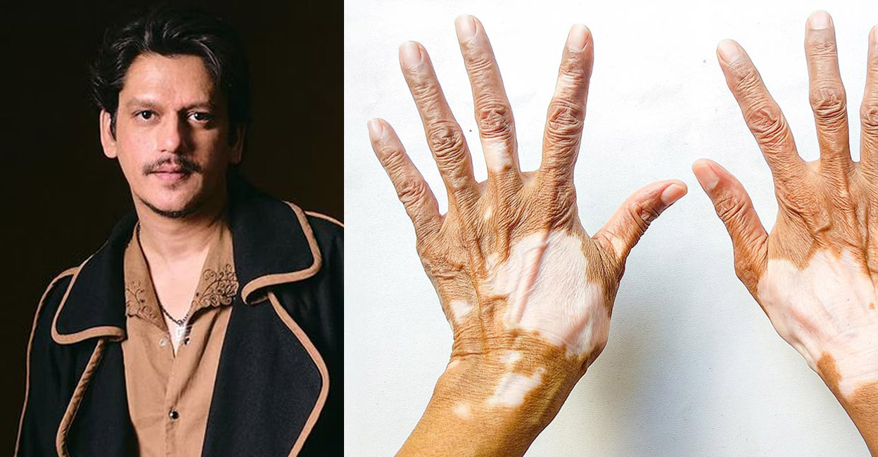 Vijay Verma said he never considered vitiligo an issue. Photo: Instagram/@vijayvarma/Shutterstock/Juliet Arza