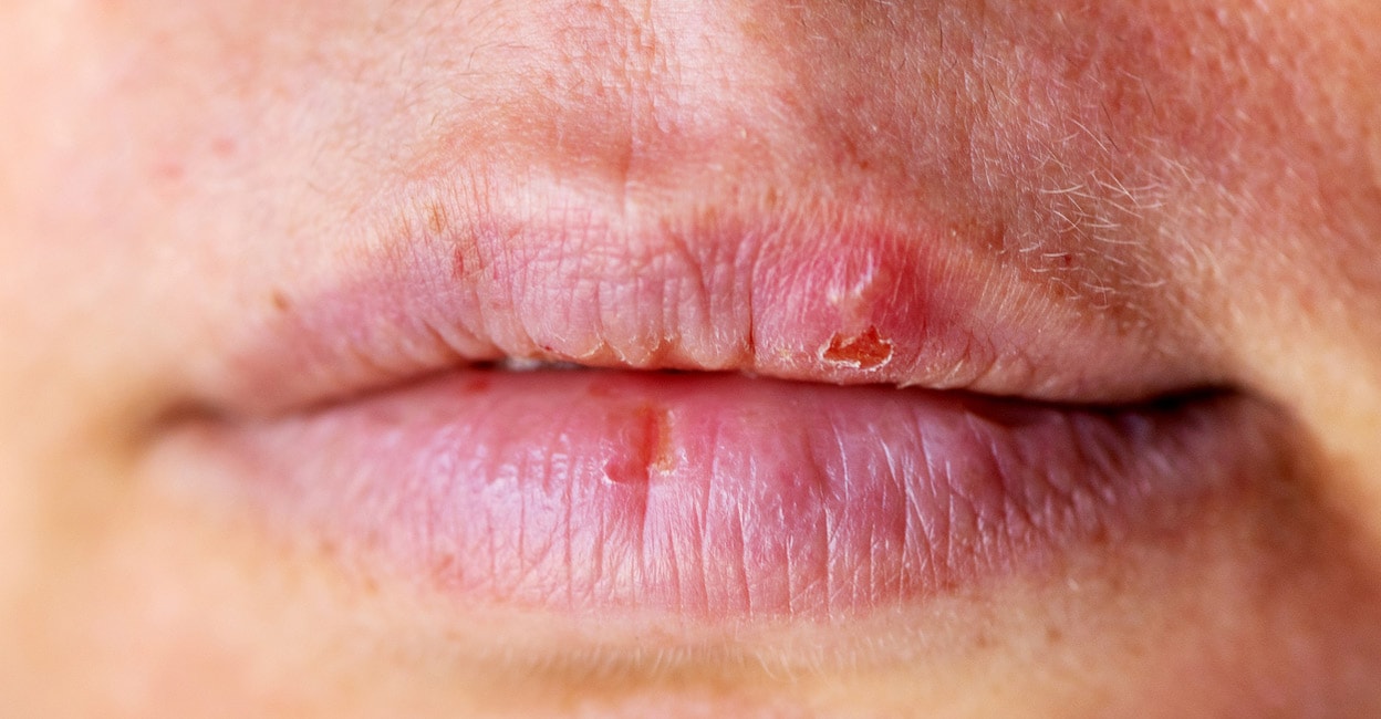 What is lip cancer? Here are the symptoms and treatment | Health ...