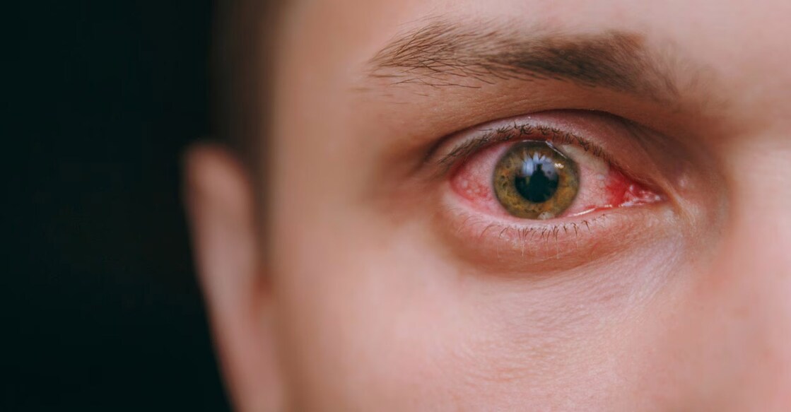  High blood pressure could contract the blood vessels in the eyes and damage the retina.