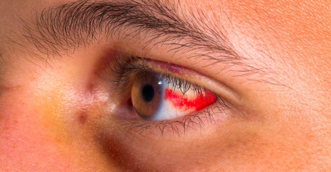 Marburg virus is currently spreading in Rwanda and Tanzania. Photo: iStock/apomares