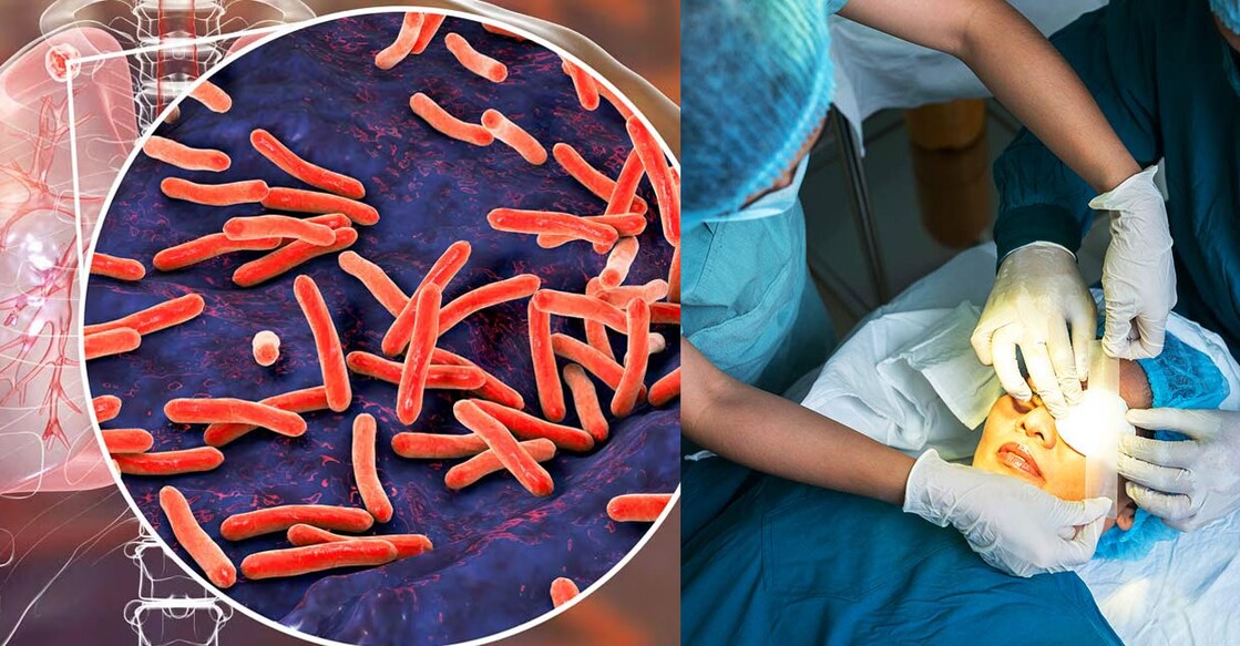 Tuberculosis (left) and cataract (right) screenings will be held in Indore in the coming weeks. Photos: iStock