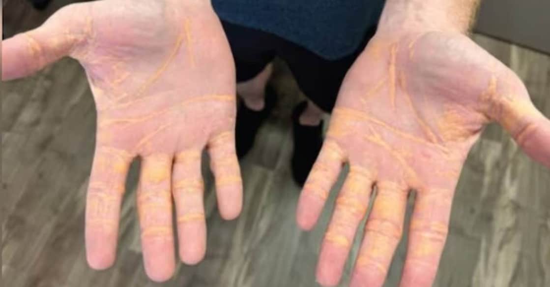 The man was following a 'carnivore diet,' which is common among weight watchers.  Photo: JAMA Cardiology