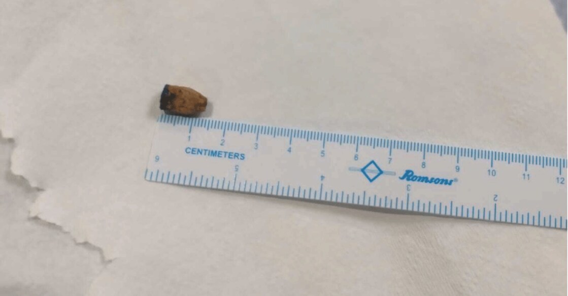 The pen cap extracted from the 26-year-old man's lungs. Photo: IANS