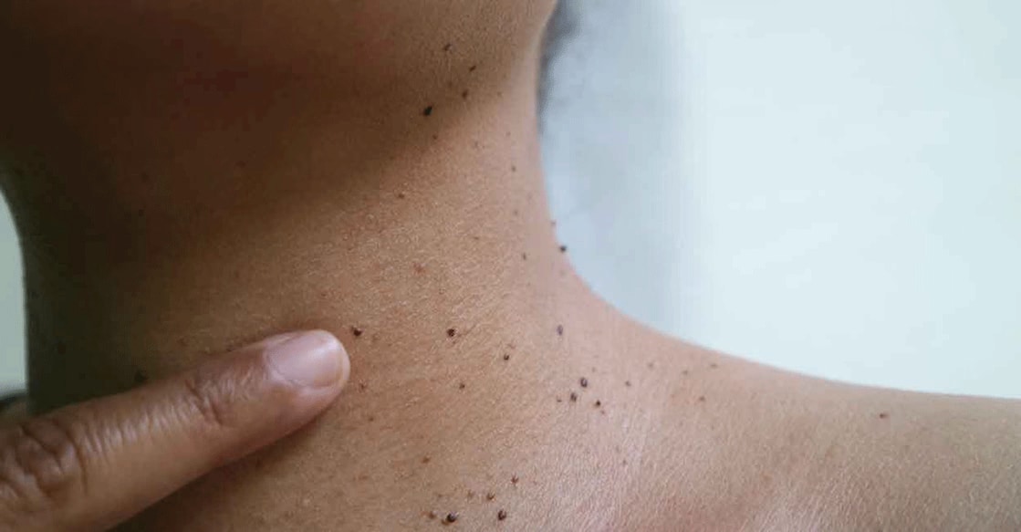 Skin tags could lead to lifestyle diseases like diabetes and heart ailments. Photo: iStock/octopus16