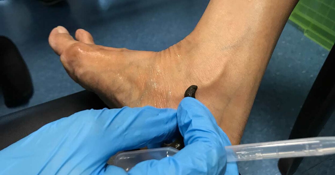 Jalaukavacharana is done using the 'nirvisha' type of leeches. Photo: cypopcolour/Shutterstock