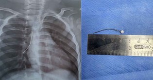 Kochi hospital removes 4 cm pin stuck in toddler’s airway