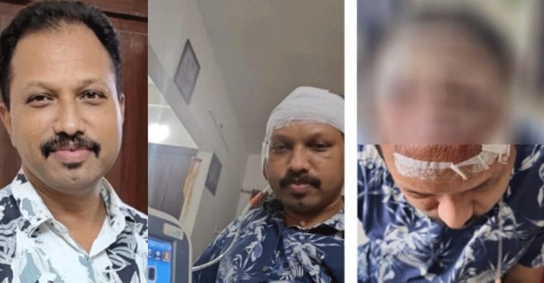 Sanil got the hair transplant done from a Kochi Clinic in February, this year. Photo: Manorama