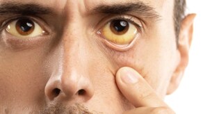 Jaundice outbreak: Know symptoms, prevention measures and treatment
