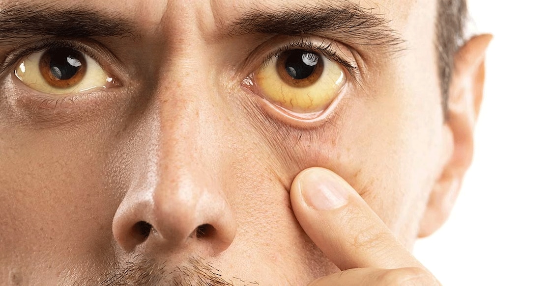 jaundice Personal hygiene, eating freshly cooked meals, drinking boiled water and keeping the surroundings clean are some effective prevention methods. Photo: iStock/Jun