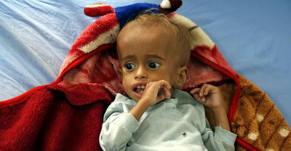 HODEIDAH, Sept. 28, 2018 (Xinhua) -- A malnourished child lies on a bed at a hospital in Hodeidah city, Yemen, on Sept. 27, 2018. (Xinhua/Mohammed Mohammed/IANS) HODEIDAH, Sept. 28, 2018 (Xinhua) -- A malnourished child lies on a bed at a hospital in Hodeidah city, Yemen, on Sept. 27, 2018. (Xinhua/Mohammed Mohammed/IANS)
