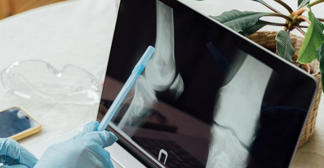 Women experience a decline in bone density after a certain age. Photo: IANS 