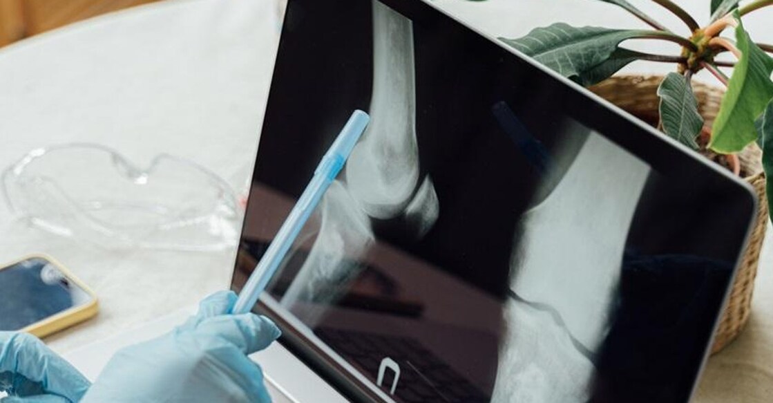 Women experience a decline in bone density after a certain age. Photo: IANS 