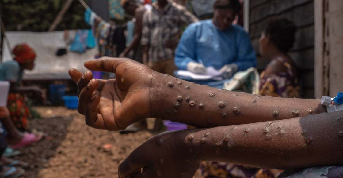 mpox-africa-c