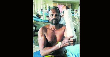 Laborer loses thumb as government docs go on strike