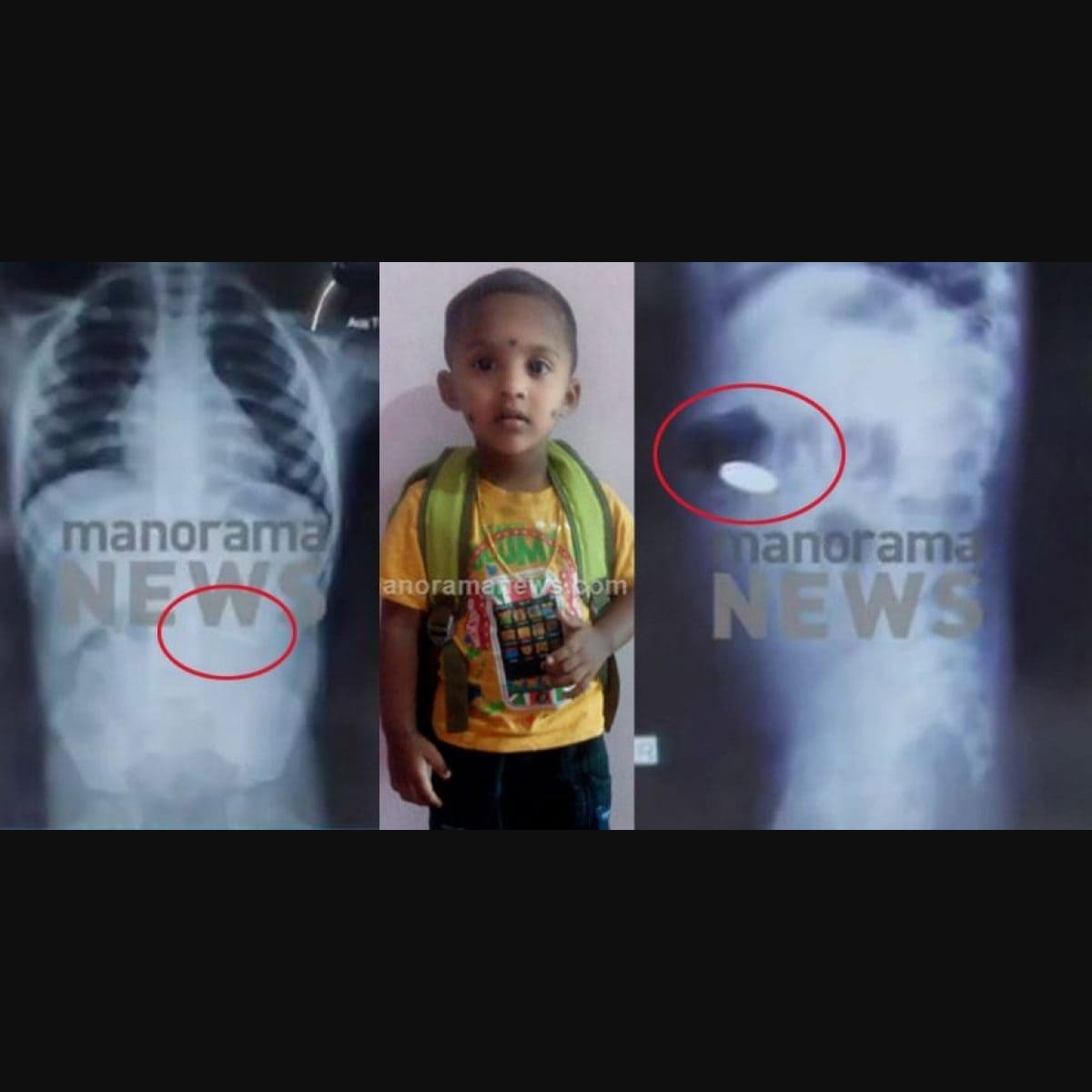 Coin swallowing case Severe pneumonia caused death of child says