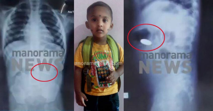 1200-coin-swallowing-kid-xray-image-845-440