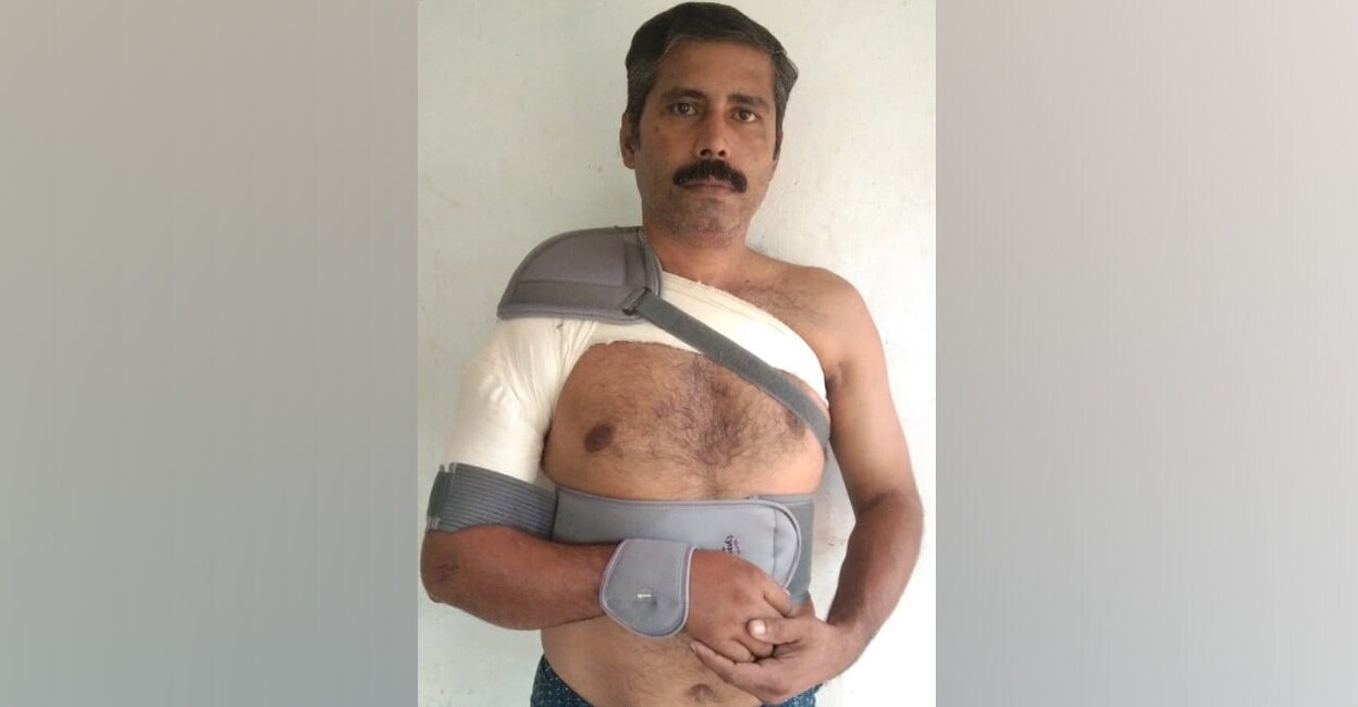 wild-boar-attack-binoy Kizhakedath Binoy suffered multiple fractures in a wild boar attack. Photo: Special arrangement