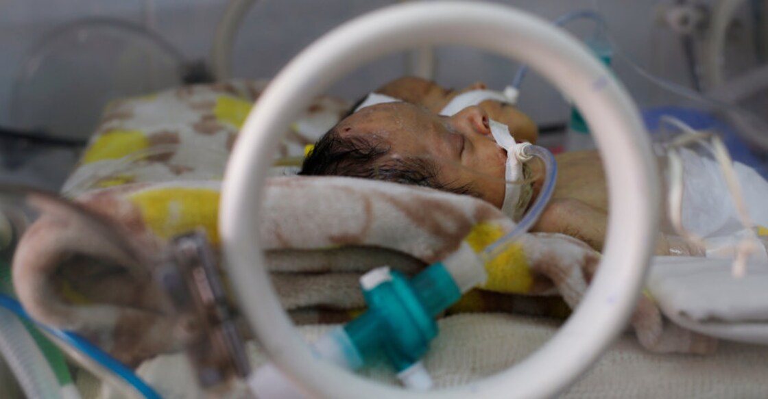Unable to fly out, conjoined twins die in Yemen without treatment