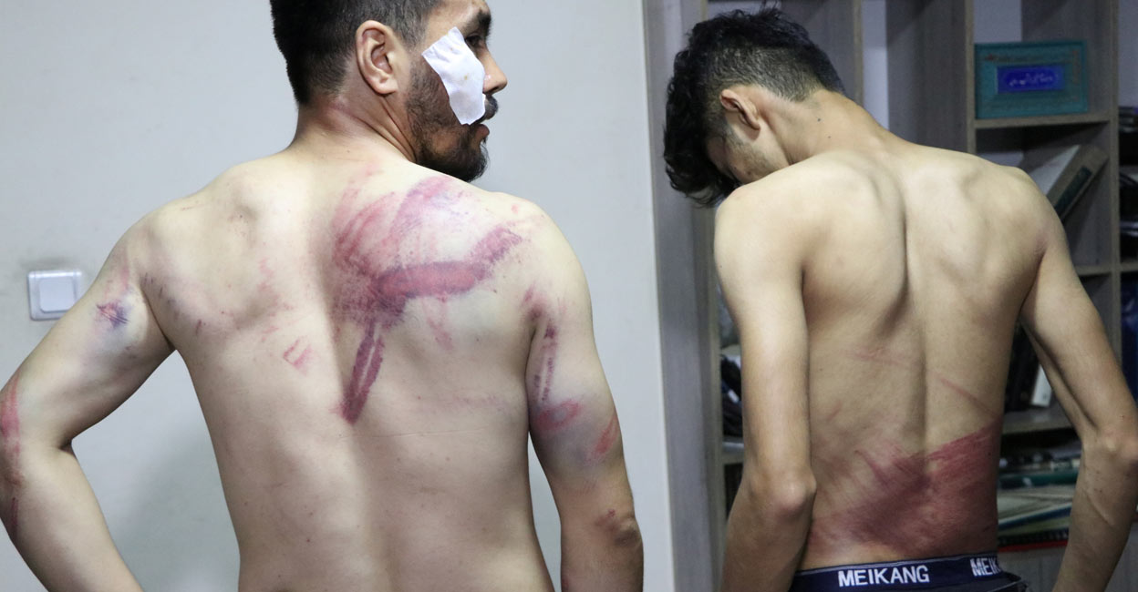 Journalists show their injuries after being beaten by the Taliban in Kabul, Afghanistan September 8, 2021 in this picture obtained from social media. Etilaatroz/via REUTERS