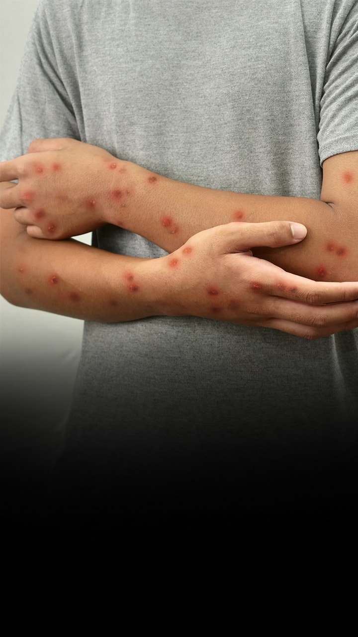 Monkeypox or mpox is a viral disease caused by the monkeypox virus, which is part of the same family as smallpox.