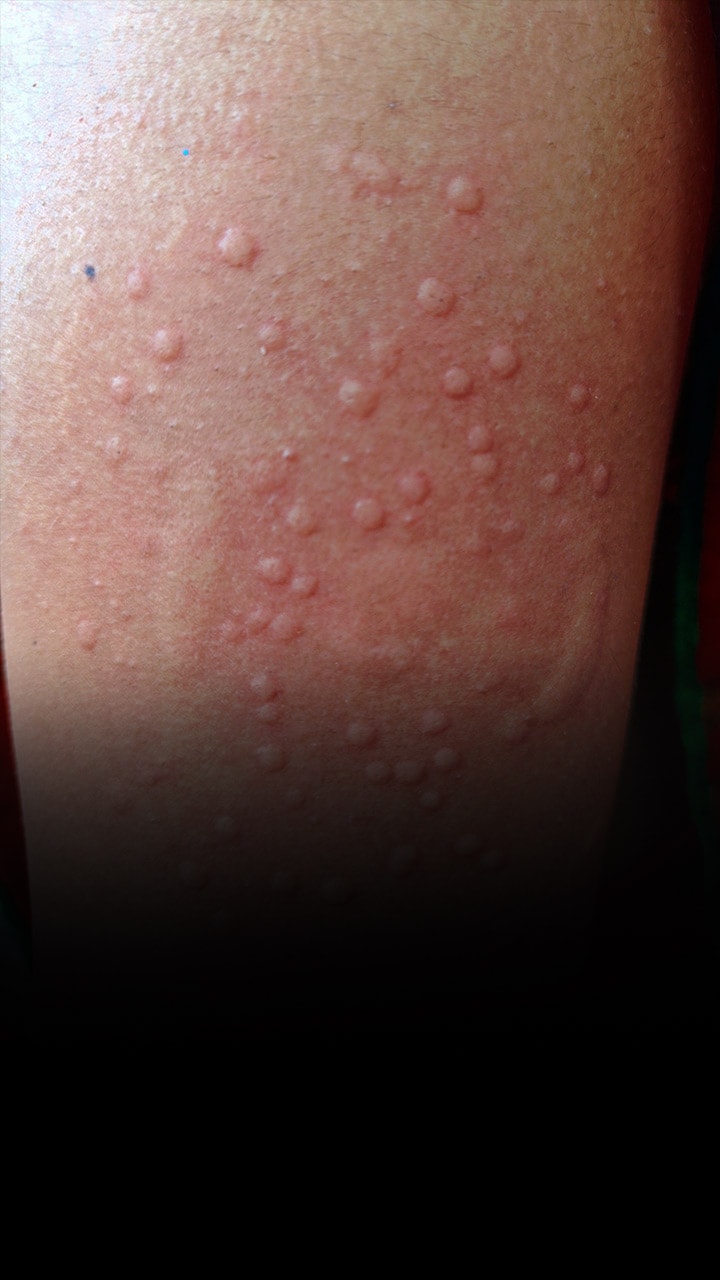 Symptoms of mpox