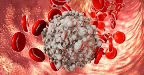 Matters of the heart | Does high blood sugar cause cancer?